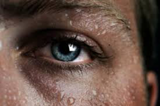 Soğuk Terleme Belirtileri ve Tedavisi